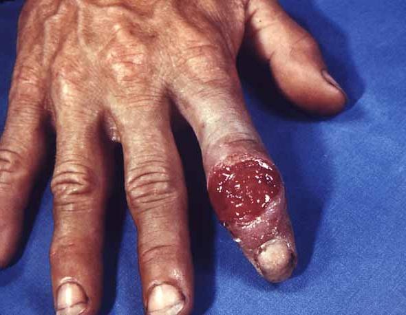 Sifilis: ligos simptomas ir gydymas