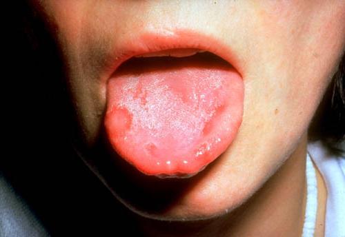 Stomatitas vaikams: simptomai ir gydymas
